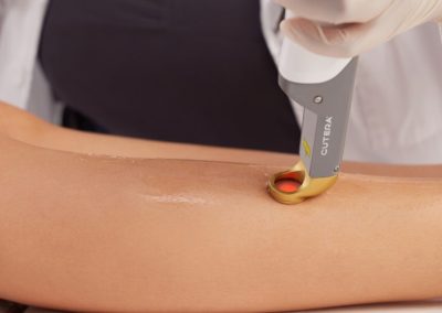 Laser – Epilazione